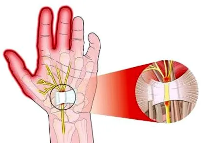 carpalis carpalis