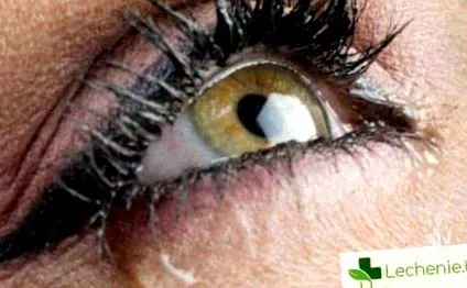 módszer blepharitis