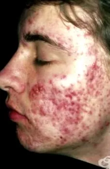 acne pattanásos konglomerátum