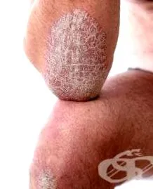 pikkelysömörhöz pikkelysömörhöz