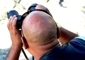 férfiaknál alopecia