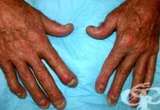 arthropathiás pikkelysömör ízületi