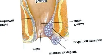 aranyér esetén