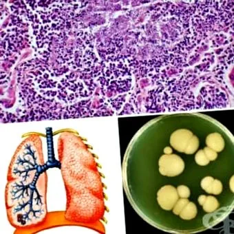 tüdő candidiasis tüdő