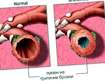 COPD kockázati COPD kockázati