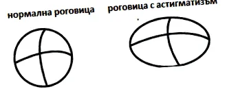 tünetek asztigmatizmus