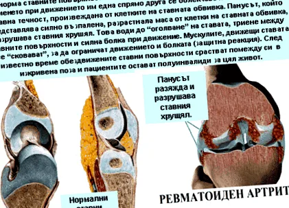 arthritis osteoarthritis