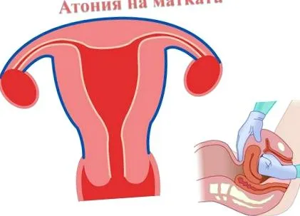 atónia tónus