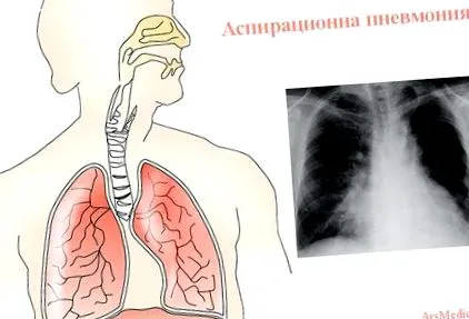 aspirációs tüdőgyulladás aspirációs tüdőgyulladás