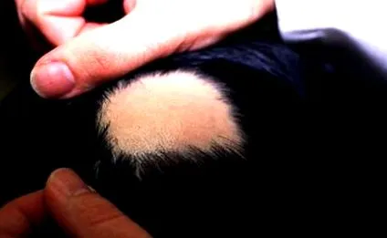 alopecia alopecia