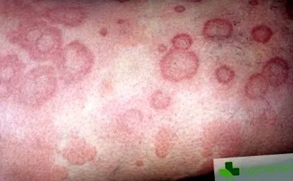 allergénnel való allergénnel való