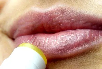 szögletes cheilitis