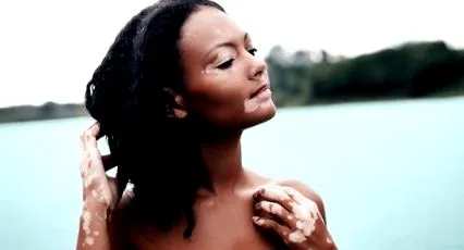 alternatív vitiligo