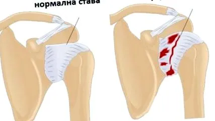 hagyományos váll