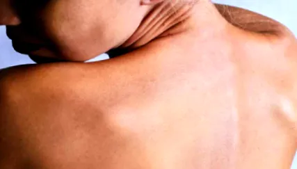 dermatitis gyógyszertári