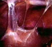 nyirok áramlását antimikrobiális antibiotikus