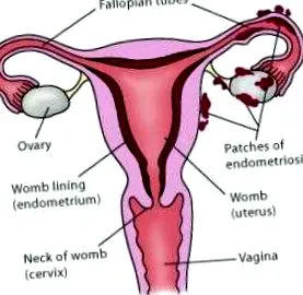 gyógynövényes endometriosis