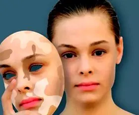 otthon vitiligo kezelésére