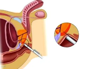 biopszia biopszia