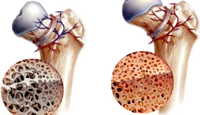 osteonekrozis osteonekrozis