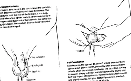 hydrocele torziós