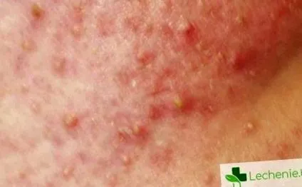 betegség mély streptoderma