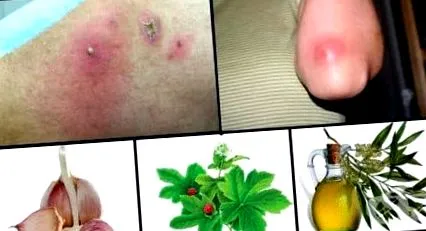 staphylococcus fertőzés