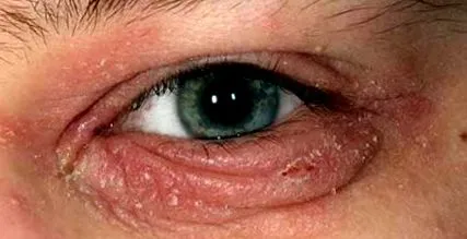 gyulladt blepharitis