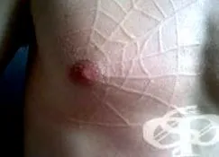 urticaria