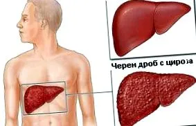 táplálkozás cirrhosis