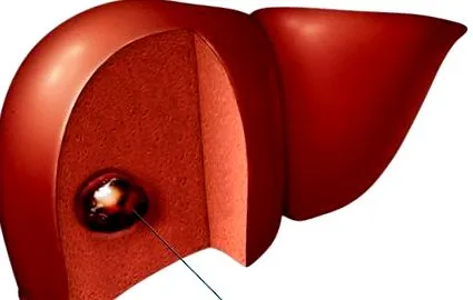 hemangioma előfordulhat bridgehealth