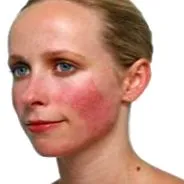 rosacea rosacea