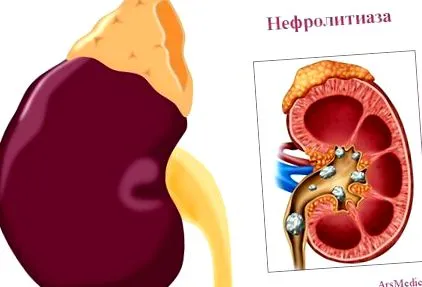vese kólika nephrolithiasis