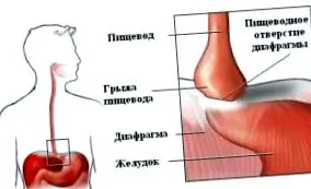esetén diéta