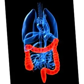 diverticulitis diverticulitis