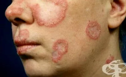 erythematosus erythematosus