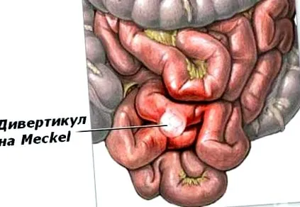 divertikuluma meckel