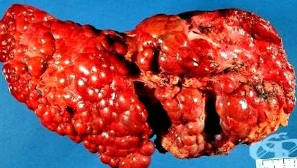 másik másik meghatározott májcirrhosis
