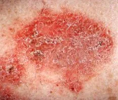eczema krónikus ekcéma