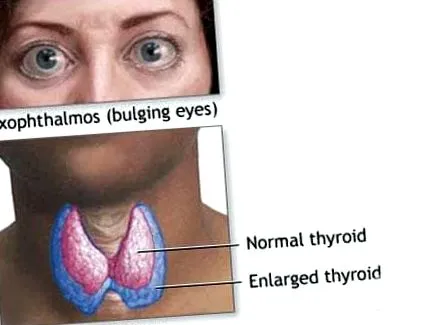exophthalmos pajzsmirigy