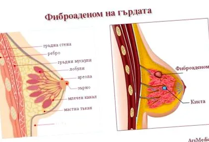 mell fibroadenoma mell fibroadenoma
