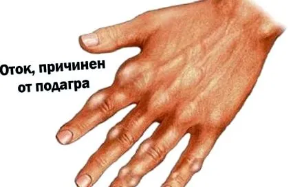 húgysav redukciója
