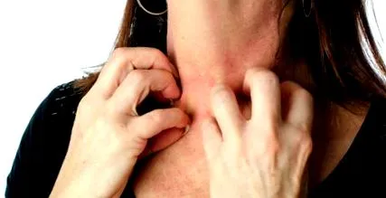 erythema multiforme