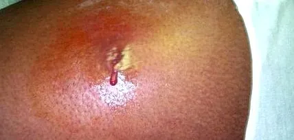 staphylococcus tudnia