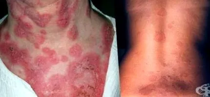 erythema Erythema marginatum