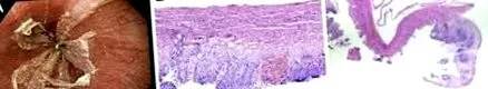 herpes simplex herpes simplex