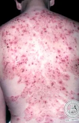 dermatitis betegség