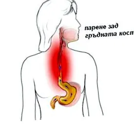 gerd reflux