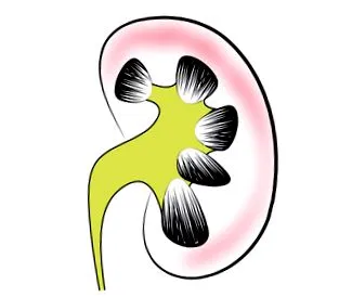 hydronephrosis állapotot sikerül