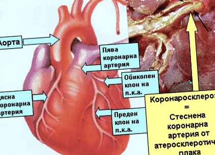 angina pectoris béka